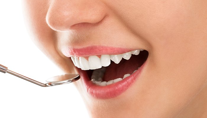 3D and 6D Veneers